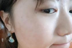 赤峰针清祛痘团购电话