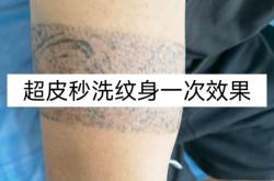 赤峰超皮秒纹身店地址电话号码