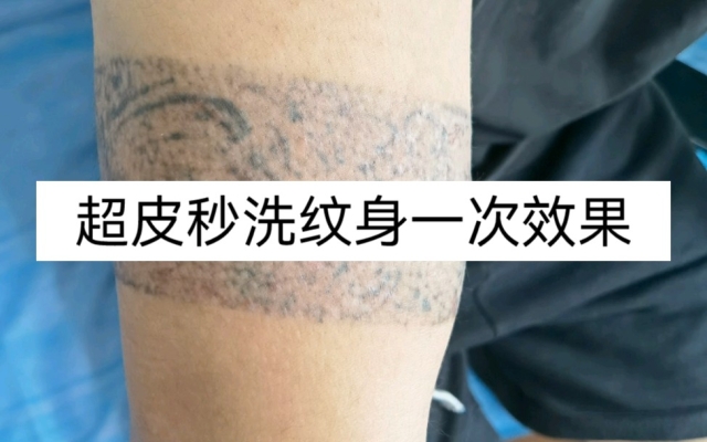 赤峰超皮秒纹身店地址电话号码-第1张图片