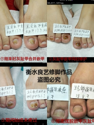 赤峰修脚趾甲店电话号码-第1张图片